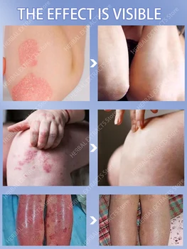 Sedef Bitkisel Krem Antibakteriyel Anti-kaşıntı Giderici Dermatit Egzama Tedavisi Soyma Urticaria Unguen